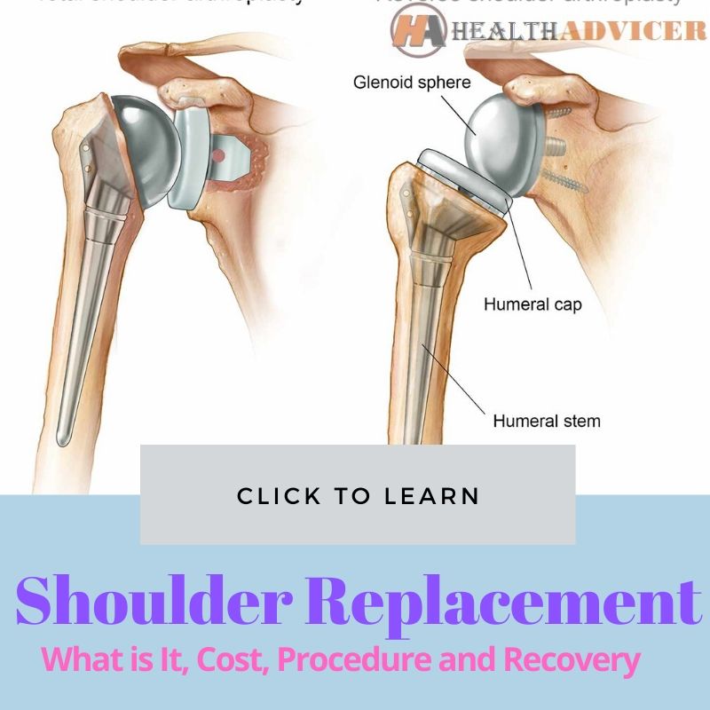 Shoulder Replacement