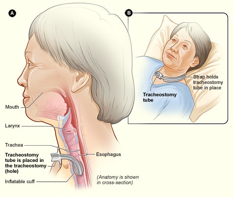 Tracheostomy