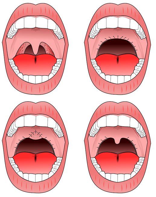 Tissue Removal