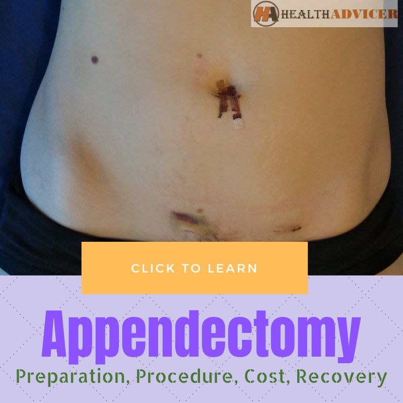 appendectomy-surgery