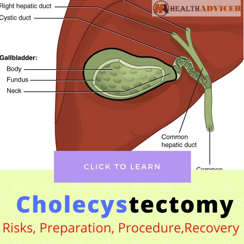 cholecystectomy-gallbladder-removal-surgery