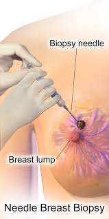 breast biopsy