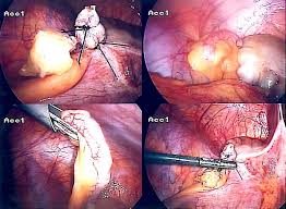 Cholecystectomy