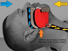 Causes Of Sleep Apnea