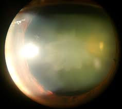 Causes Of Cataract