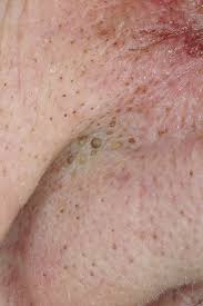 Blackheads