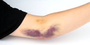 Hematoma