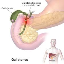 Presence Of Gallstones