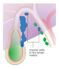 Gallbladder Cancer