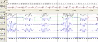 Nocturnal Polysomnography