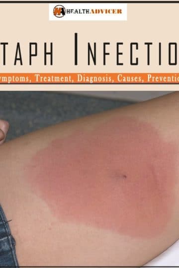 staph infection Causes Treatment