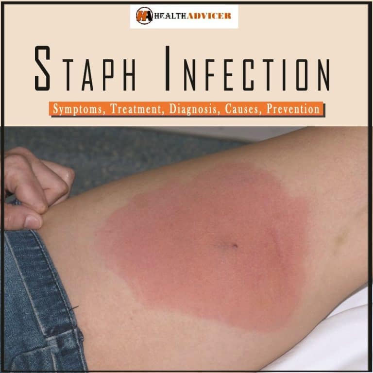 Staph Infection Causes, Symptoms, Diagnosis And Treatment