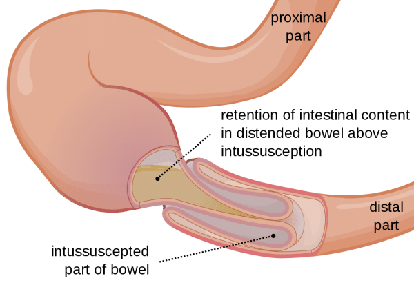 Causes Of Intestinal Blockage In Infants