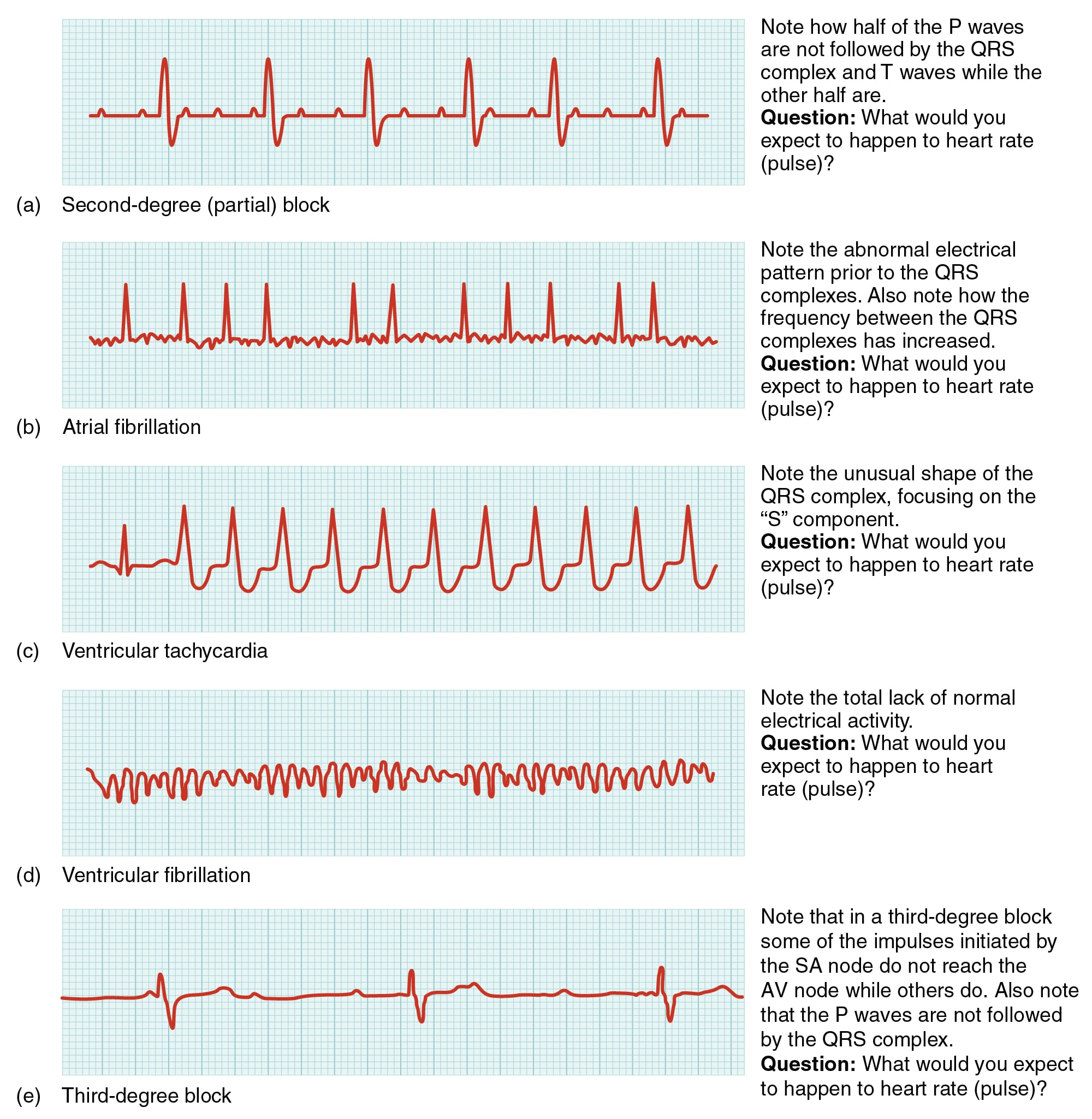 Syncope