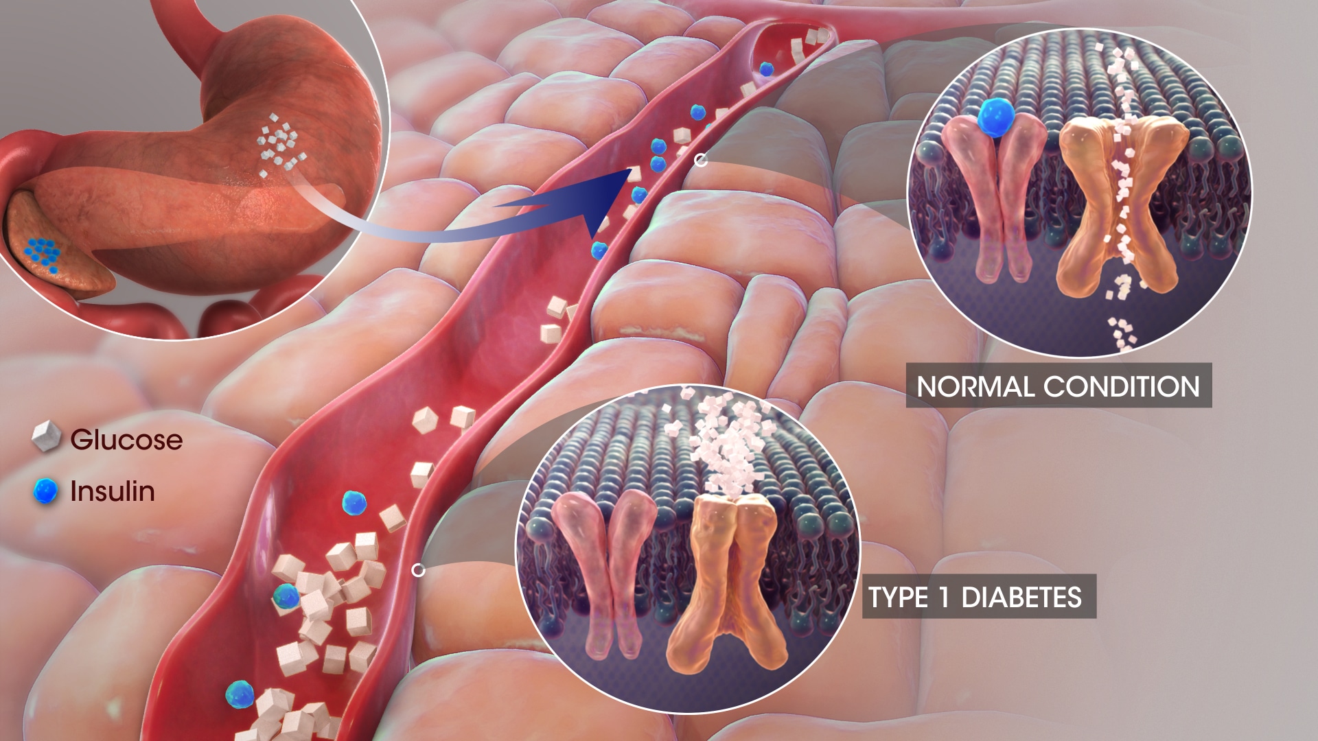 Causes Of Type 1 Diabetes