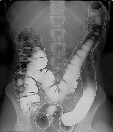  Air and Barium Enema