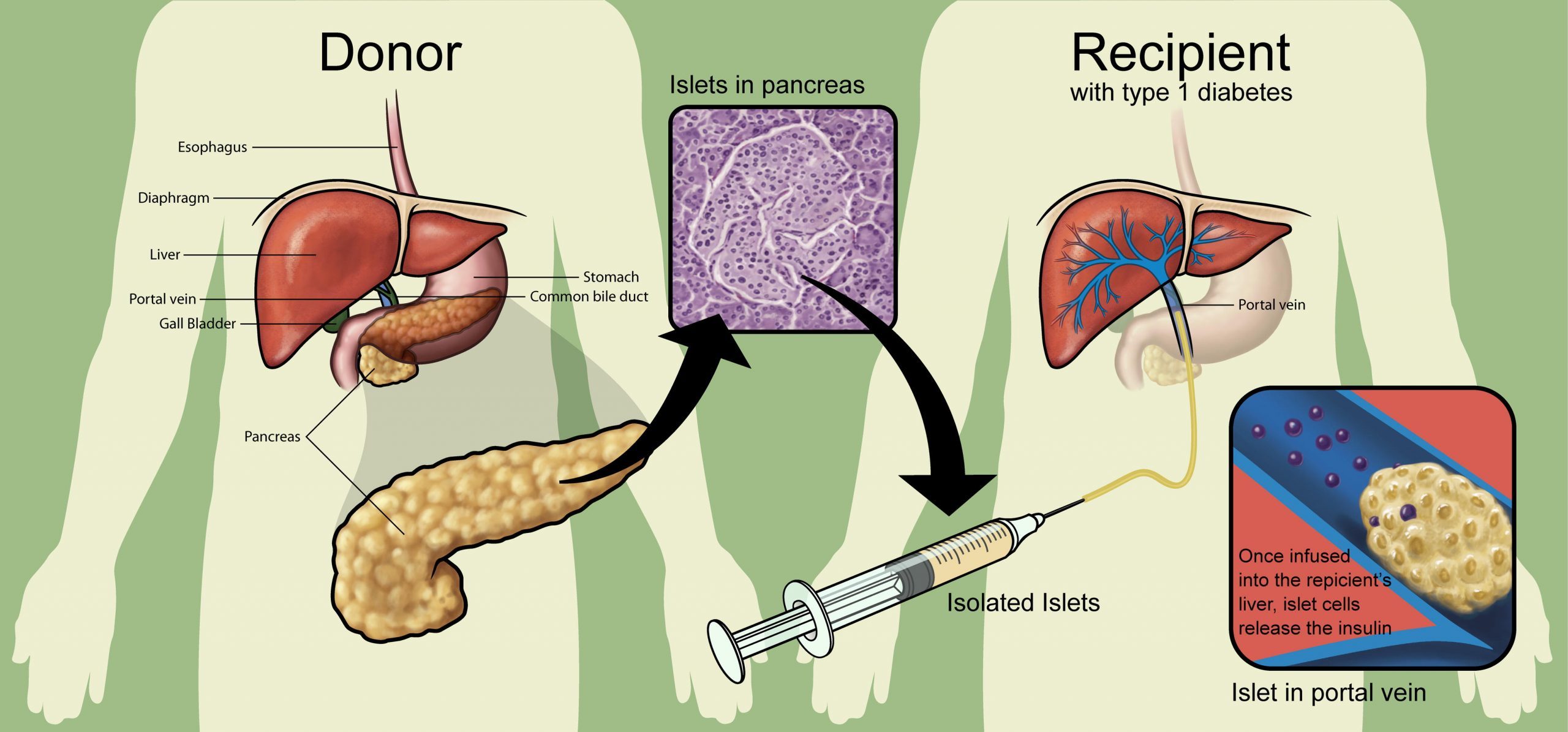 Islet Cell Transplantation