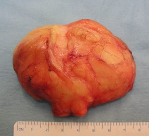 Lipoma