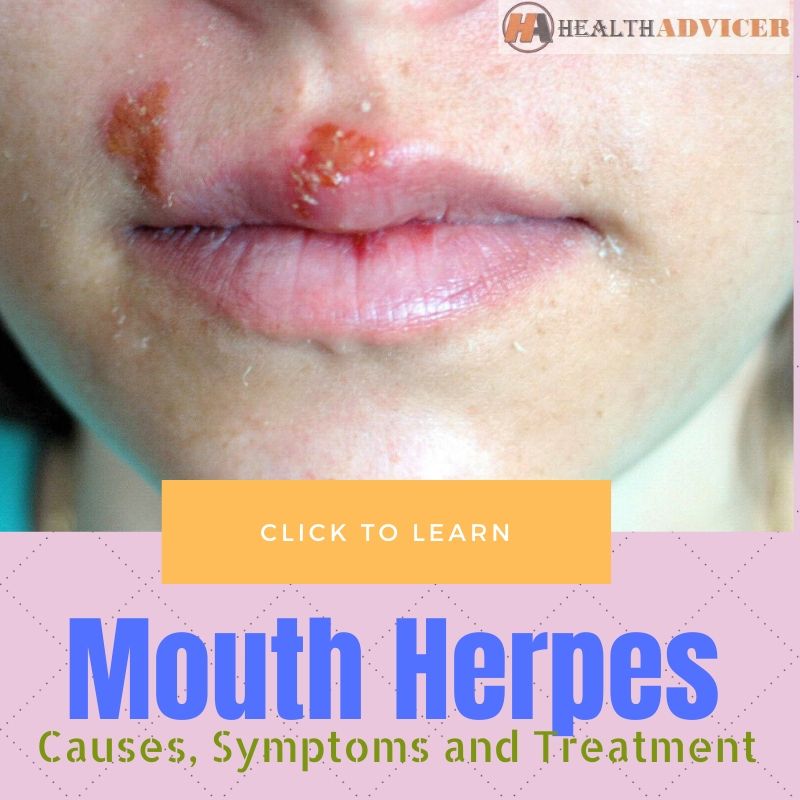 Mouth Herpes Causes Treatment
