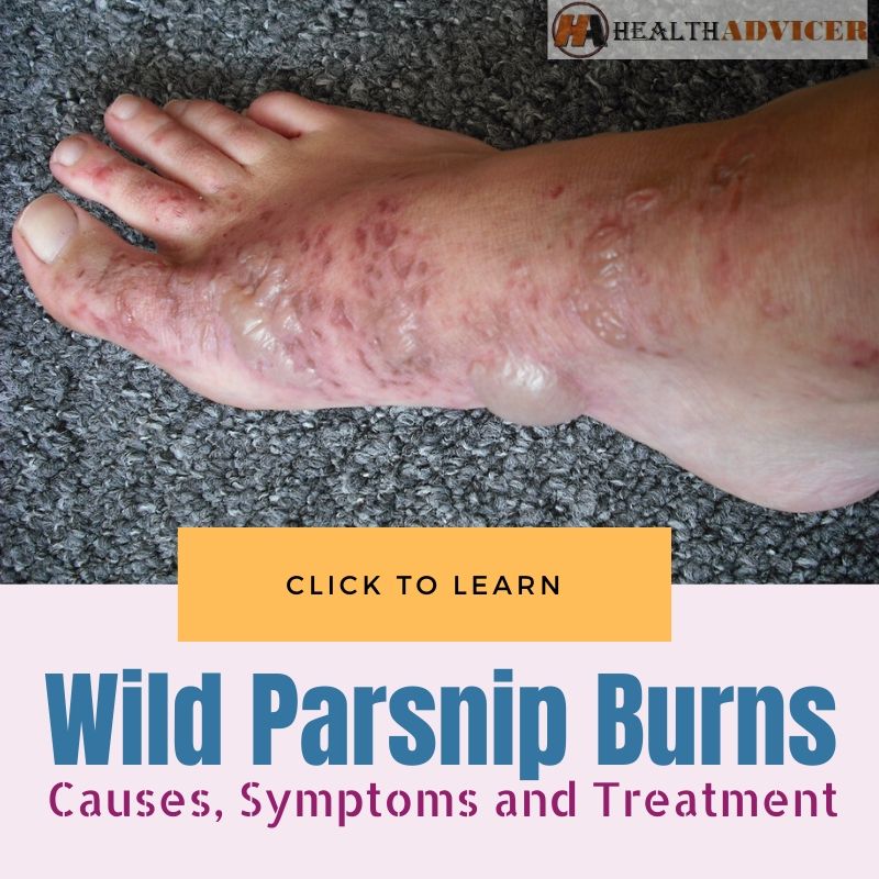 Wild Parsnip Burns