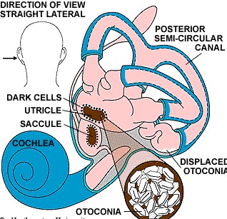 Benign paroxysmal positional vertigo (BPPV)