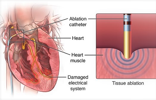 Cardiac ablation
