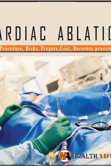 cardiac ablation