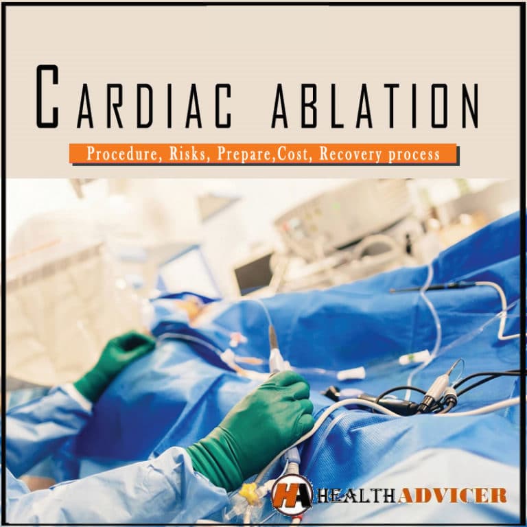Cardiac Ablation Procedure, Risks, Prepare, Cost, Recovery Process