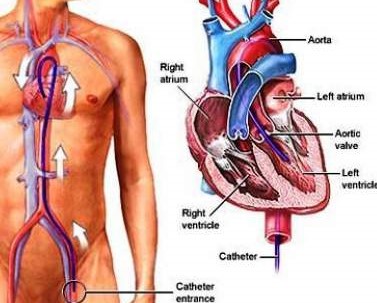 Results Of Cardiac Ablation