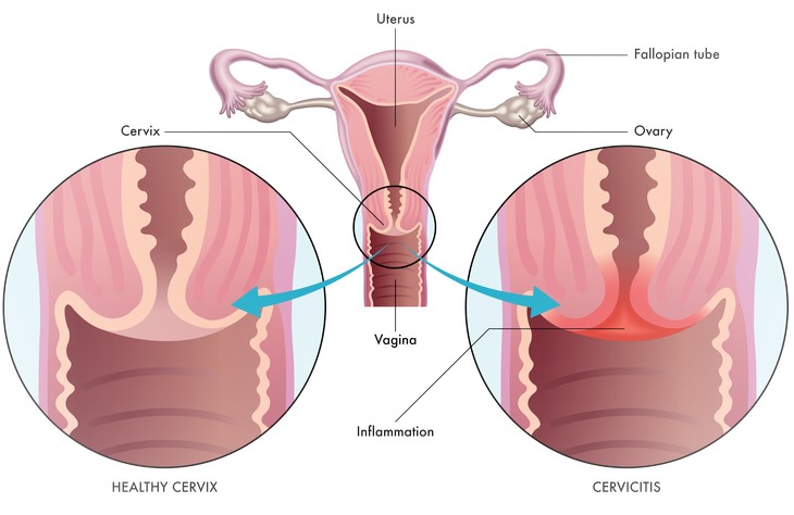Cervix Infection