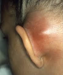 Mastoiditis