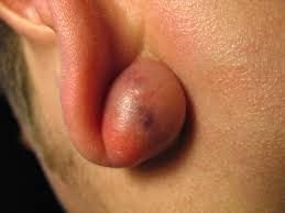 Sebaceous Cysts