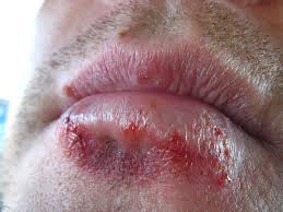 Symptoms Of Mouth Herpes