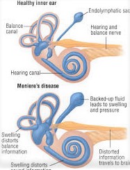 Meniere's disease