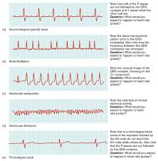 Need For Cardiac Ablation Procedure