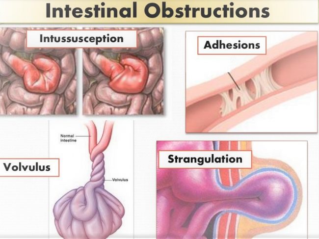 Mechanical Obstructions