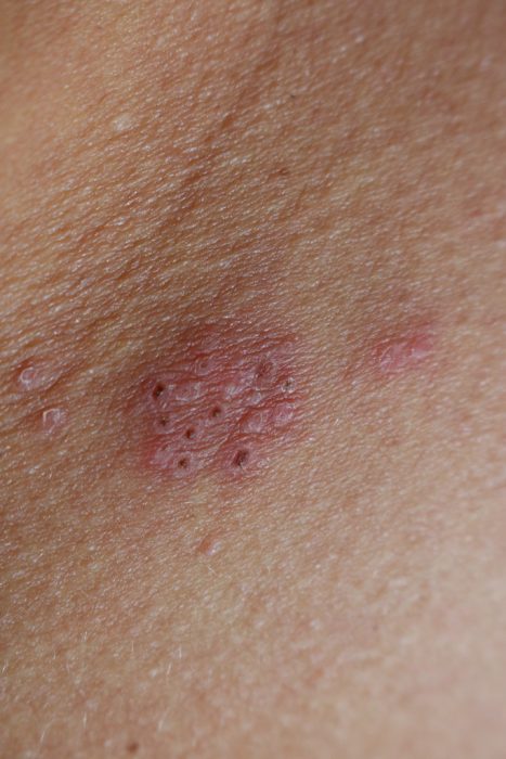 Chickenpox And Shingles