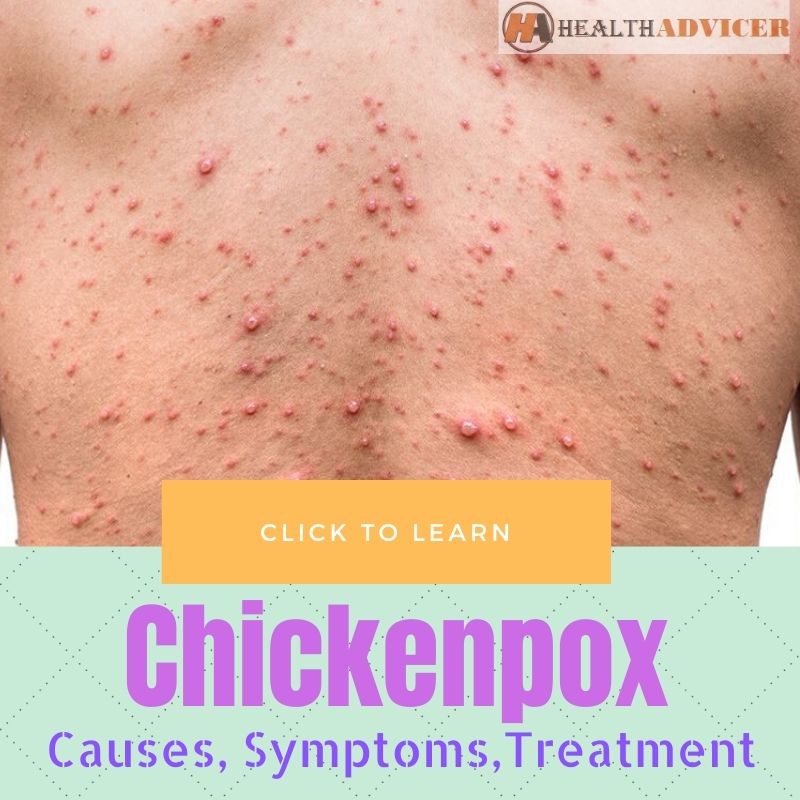 Chickenpox Causes Treatment