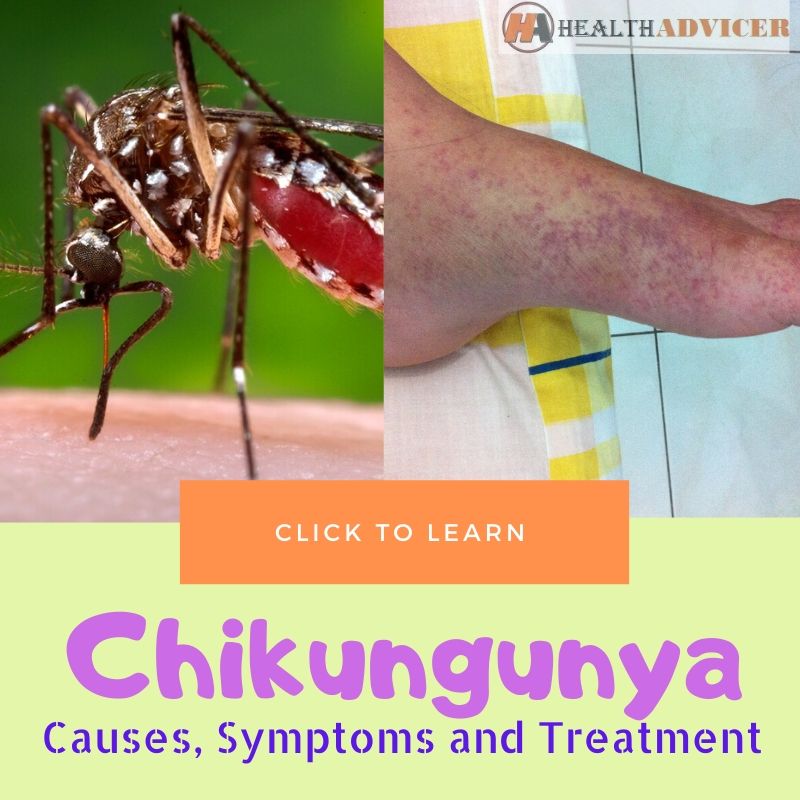 Chikungunya Causes Treatment