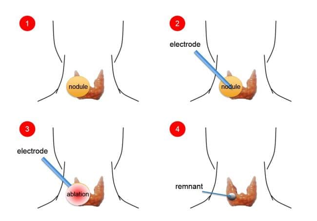 Thyroid Disorders Treatment