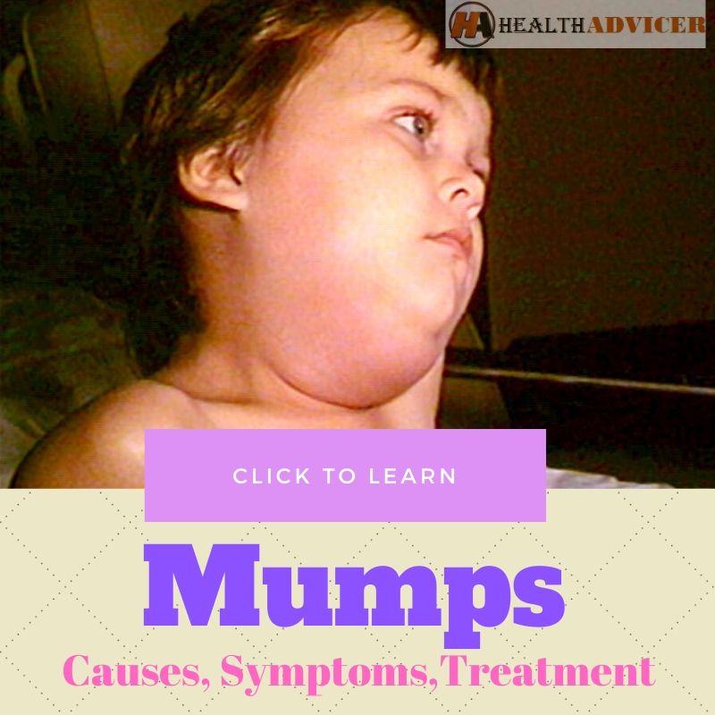 Mumps Causes Treatment
