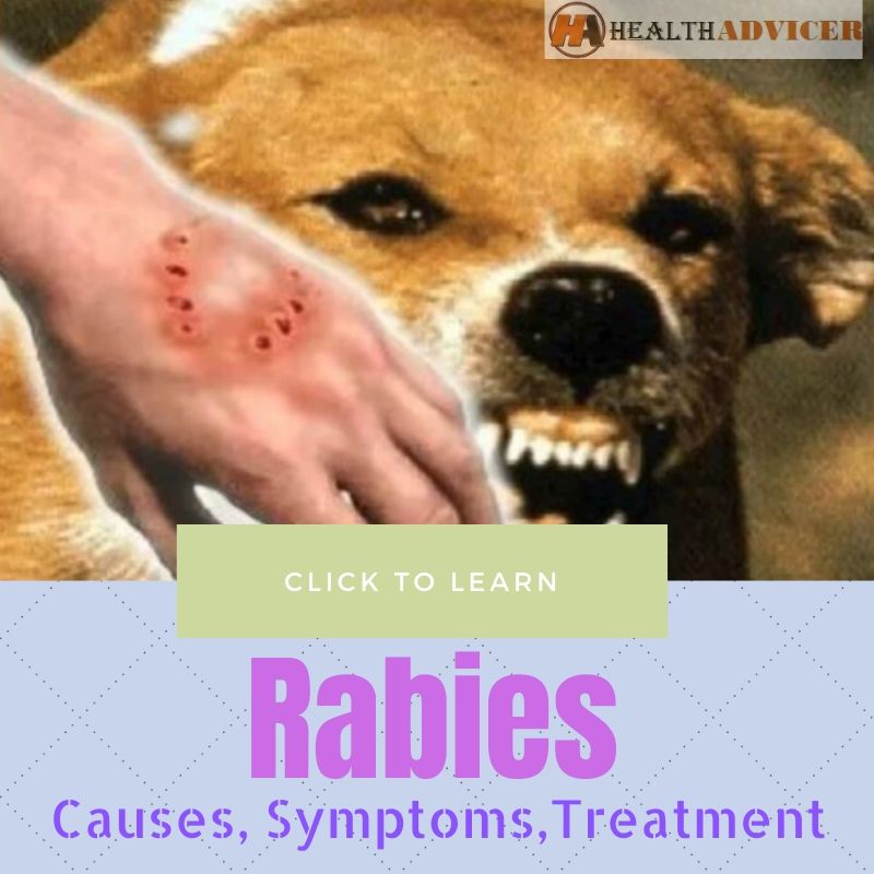 Rabies Causes Treatment
