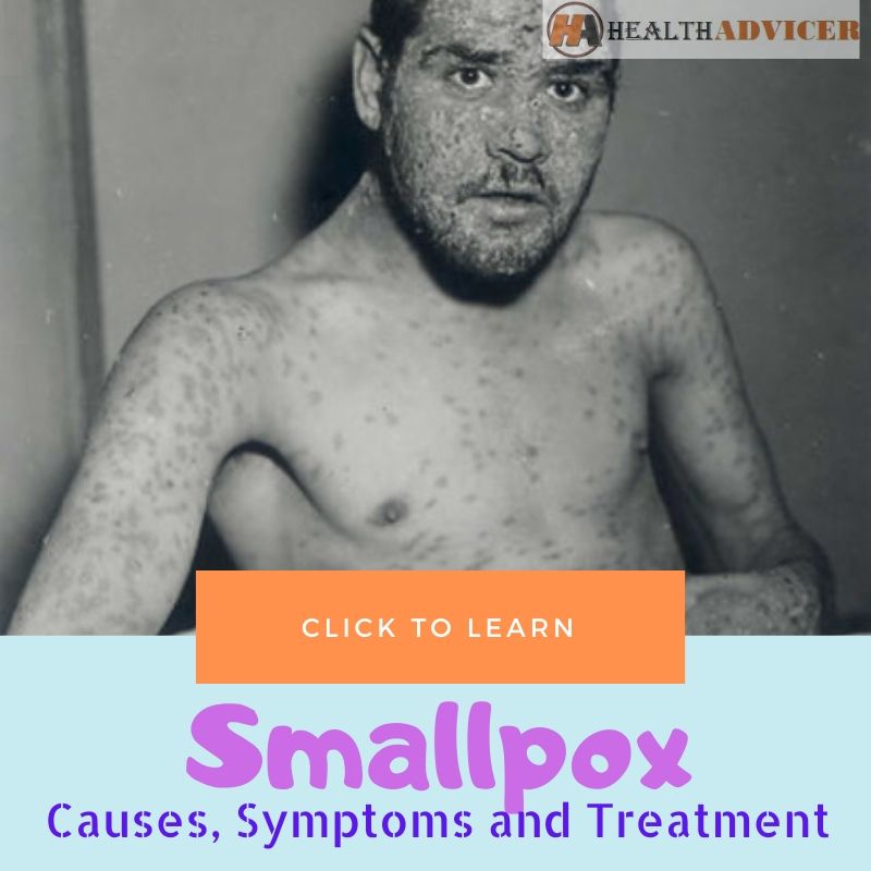 Smallpox Causes Treatment