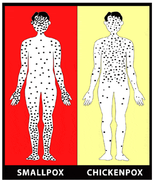 Diagnosis Of Smallpox