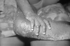 Monkeypox