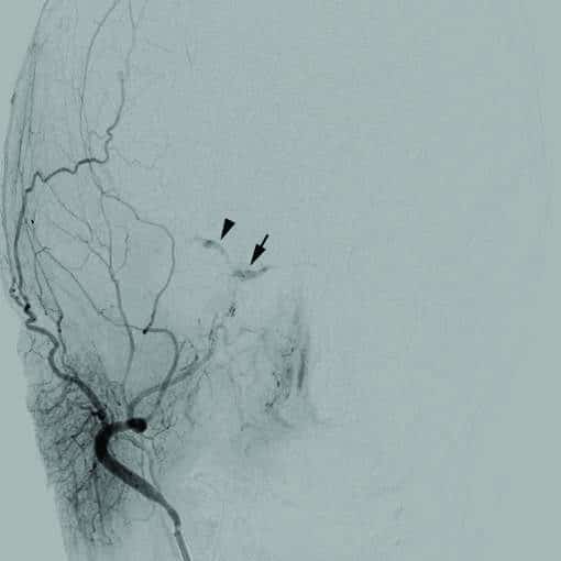 Cerebral Angiogram