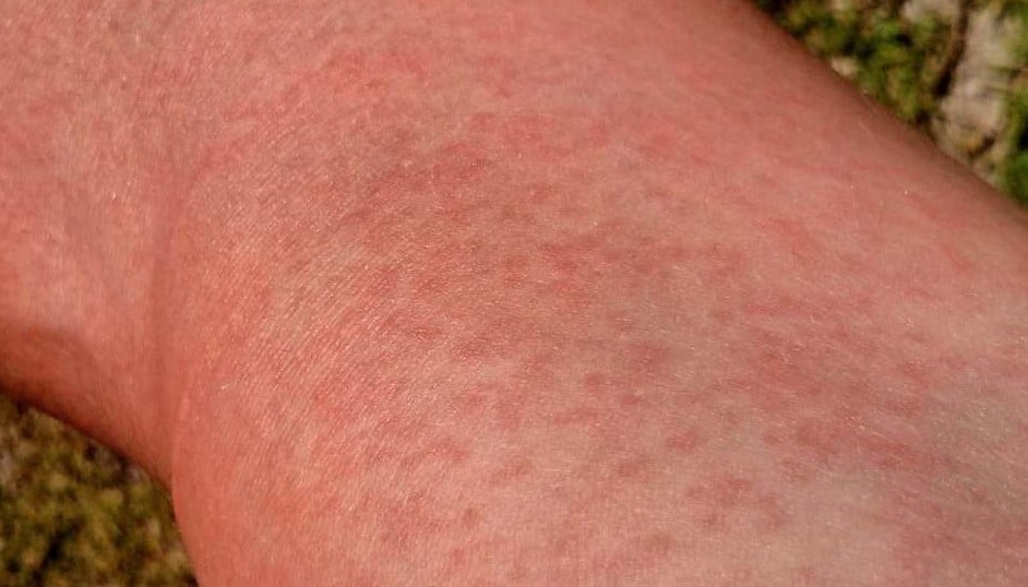 Maculopapular Rash