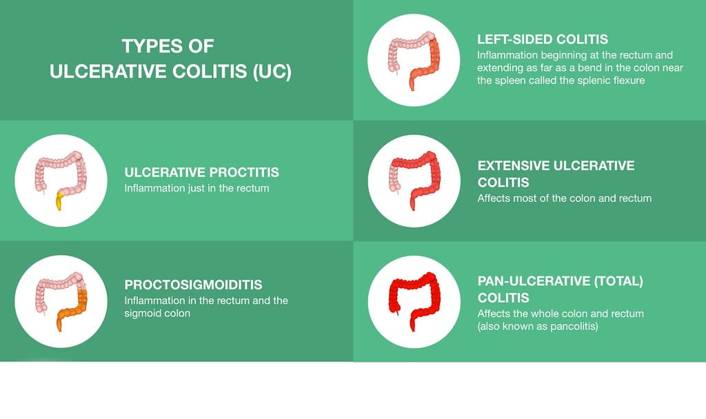 Ulcerative Colitis