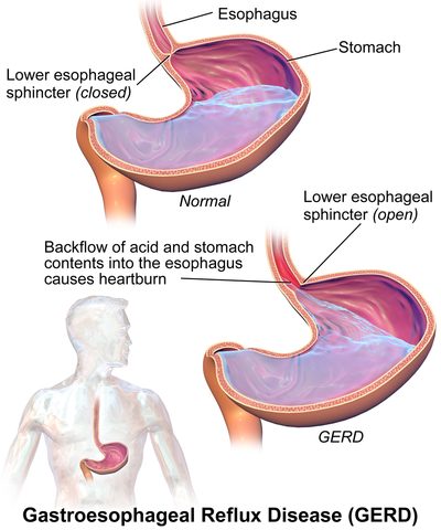 Manage Acid Reflux