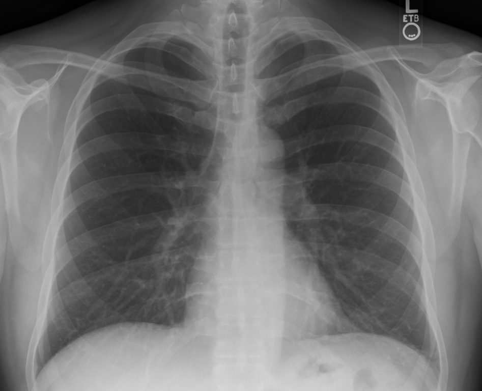 A Chest X-ray